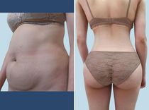 Hút mỡ bụng có nguy hiểm không? 5 rủi ro bạn nên biết