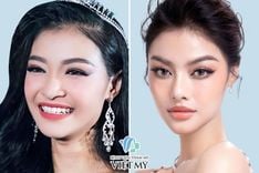 Nâng mũi sụn sườn và tất cả những điều bạn cần biết trước khi phẫu thuật