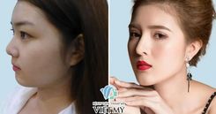 Nâng mũi cấu trúc