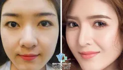 Sự khác nhau giữa cắt mí và bấm mí hay nhấn mí - bác sĩ Chiêm Quốc Thái