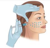 Mesotherapy điều trị nám