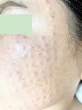 Mesotherapy trẻ hóa da