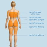 Hút mỡ căng da các vùng: cằm, tay, nách, đùi