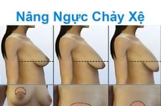 Nâng ngực chảy xệ - Bác sĩ Chiêm Quốc Thái