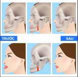 Phẫu thuật điều trị hàm móm: Giải pháp tối ưu để cải thiện chức năng và thẩm mỹ
