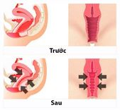 Phẫu thuật thu nhỏ âm đạo