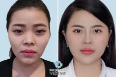 Làm đầy vùng mặt bằng mỡ tự thân