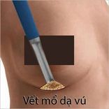 Nâng ngực mổ hở nếp dạ vú