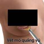 Nâng ngực mổ hở quầng vú