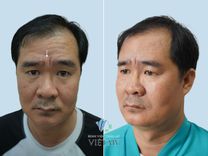 Xoá nhăn cau mày: Cách giảm thiểu và ngăn ngừa nếp nhăn giữa hai chân mày 
