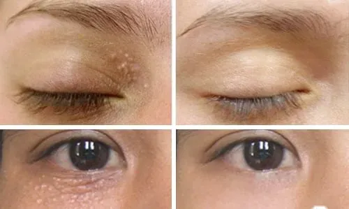 Laser fractional CO2: Với công nghệ Laser CO2 vi điểm, chùm Laser được phân cắt đoạn thành rất nhiều tia cực nhỏ khi đến tác động lên da. Các vùng nhỏ giữa các tia sẽ không chịu tác động và vẫn còn nguyên vẹn,...
