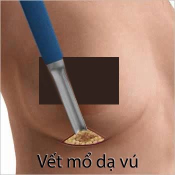 Nâng ngực mổ hở nếp dạ vú