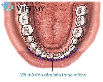 Vết mổ độn cằm bên trong miệng.