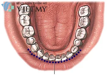 Đường mổ trượt cằm