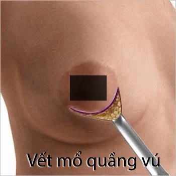 Nâng ngực mổ hở quầng vú